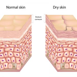 טיפול בעור יבש