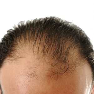 טיפול בנשירת שיער